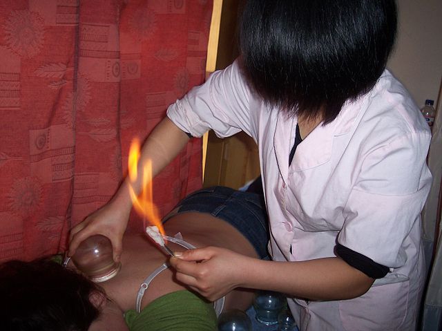 cupping therapy Chinese Medicine 