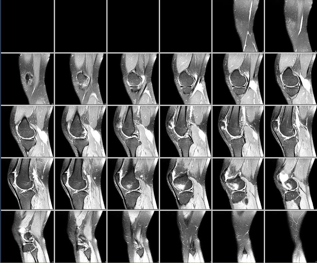 Сделать мрт коленного сустава. Артроз коленного сустава мрт снимок. Мрт суставов (коленный сустав с одной стороны). Снимок мрт здорового коленного сустава. Снимки мрт здорового коленного сустава.